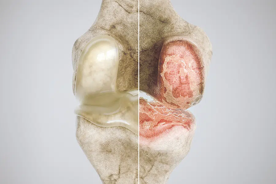 Artrosi ginocchio FisioNovara